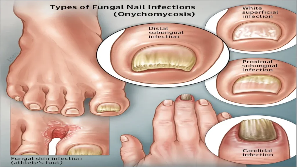 Exofeet oil - účinky - recenzie - cena - nazor odbornikov - komentáre - zloženie - Slovensko - kúpiť - lekáreň